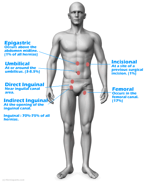 Typical hernia locations in the body